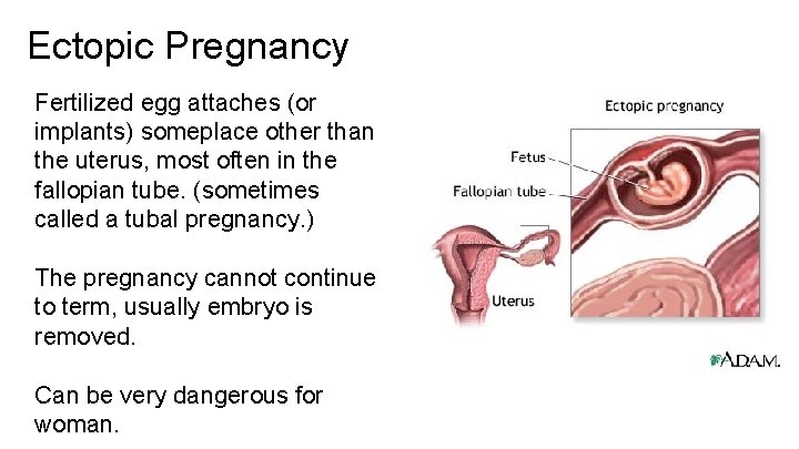 Ectopic Pregnancy Fertilized egg attaches (or implants) someplace other than the uterus, most often