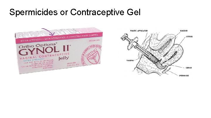 Spermicides or Contraceptive Gel 