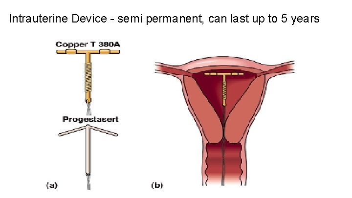 Intrauterine Device - semi permanent, can last up to 5 years 