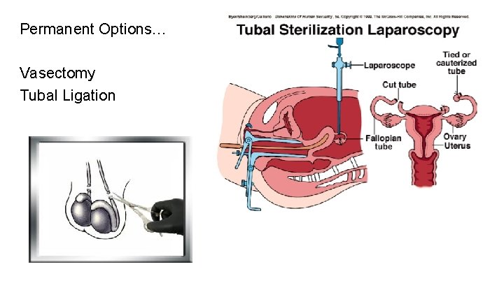 Permanent Options… Vasectomy Tubal Ligation 