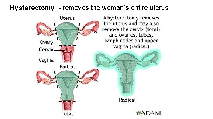 Hysterectomy - removes the woman’s entire uterus 