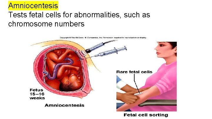Amniocentesis Tests fetal cells for abnormalities, such as chromosome numbers 