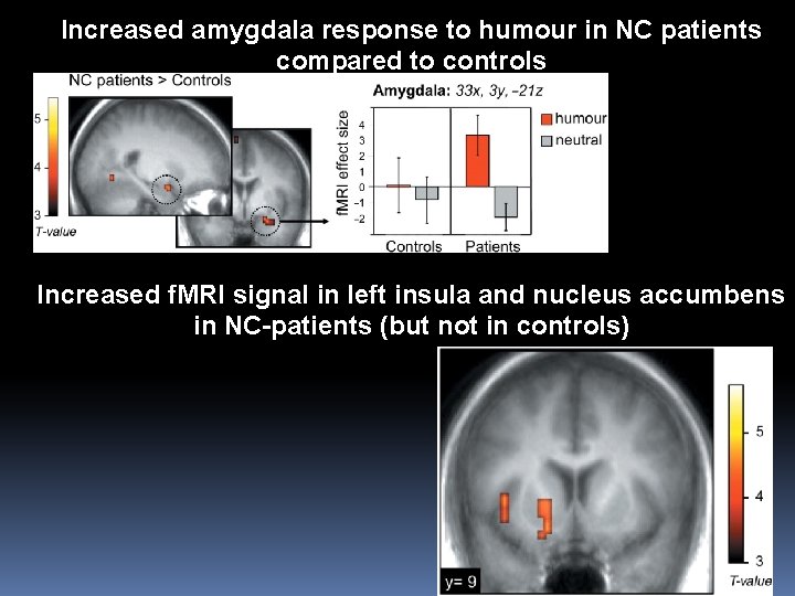 Increased amygdala response to humour in NC patients compared to controls Increased f. MRI