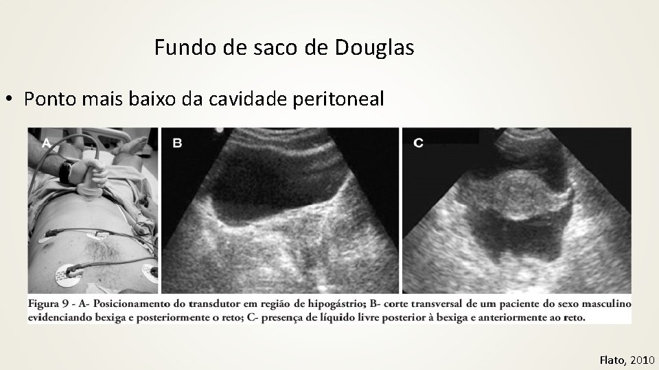 Fundo de saco de Douglas • Ponto mais baixo da cavidade peritoneal Flato, 2010