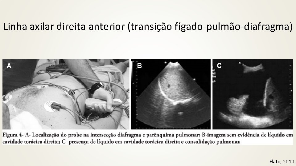 Linha axilar direita anterior (transição fígado-pulmão-diafragma) Flato, 2010 