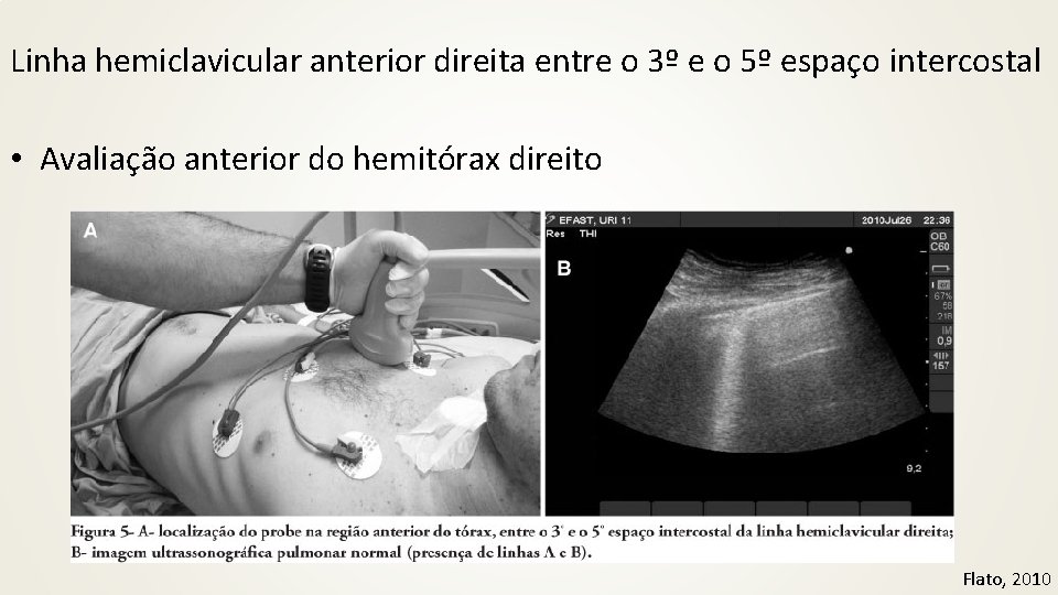 Linha hemiclavicular anterior direita entre o 3º e o 5º espaço intercostal • Avaliação