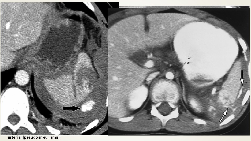 Sangramento ativo: linear = veia jorrando; arredondada = arterial (pseudoaneurisma) 