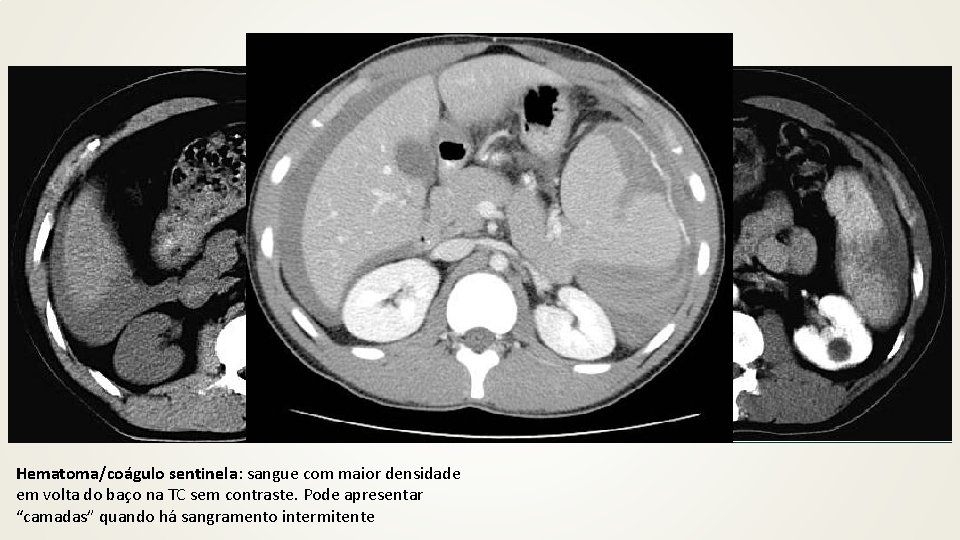 Hematoma/coágulo sentinela: sangue com maior densidade em volta do baço na TC sem contraste.
