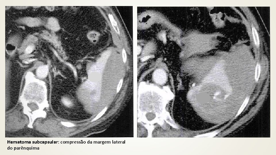 Hematoma subcapsular: compressão da margem lateral do parênquima 