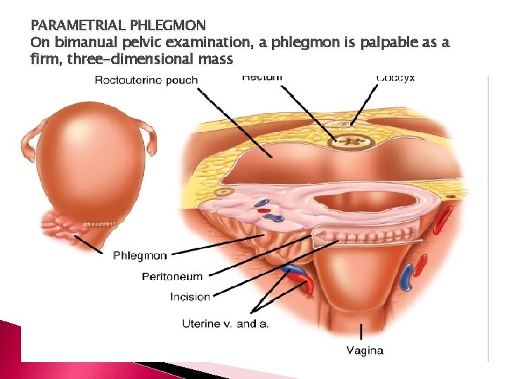 PARAMETRIAL PHLEGMON On bimanual pelvic examination, a phlegmon is palpable as a firm, three-dimensional