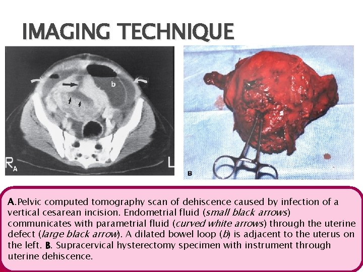 IMAGING TECHNIQUE A. Pelvic computed tomography scan of dehiscence caused by infection of a