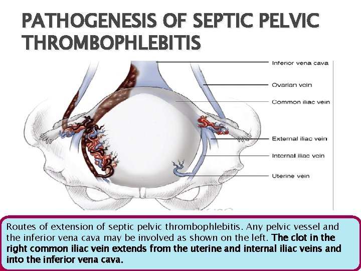PATHOGENESIS OF SEPTIC PELVIC THROMBOPHLEBITIS Routes of extension of septic pelvic thrombophlebitis. Any pelvic