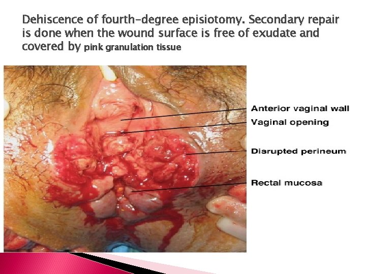 Dehiscence of fourth-degree episiotomy. Secondary repair is done when the wound surface is free