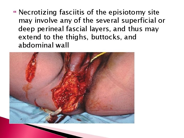  Necrotizing fasciitis of the episiotomy site may involve any of the several superficial