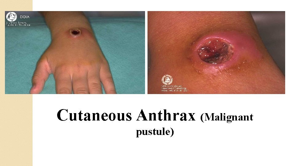 Cutaneous Anthrax (Malignant pustule) 
