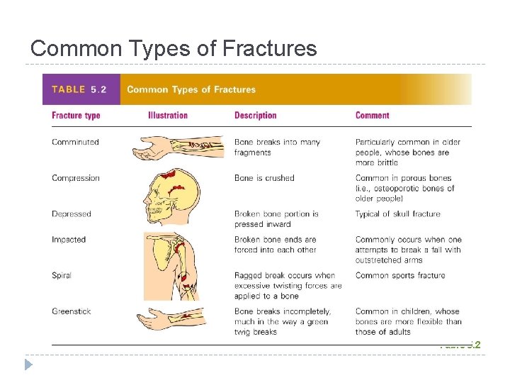 Common Types of Fractures Table 5. 2 