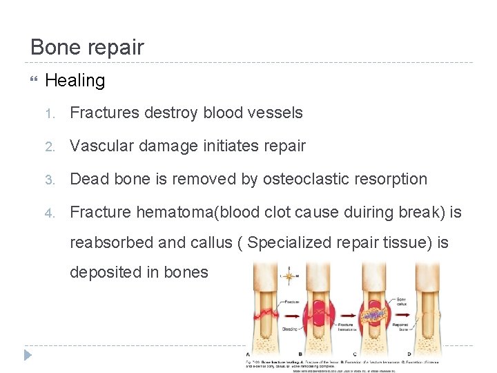 Bone repair Healing 1. Fractures destroy blood vessels 2. Vascular damage initiates repair 3.