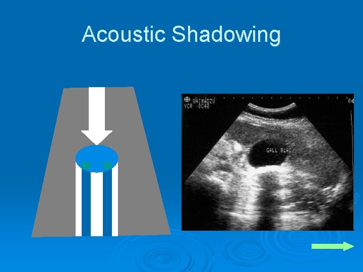 Acoustic Shadowing 