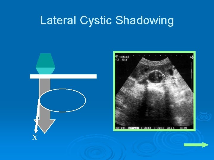 Lateral Cystic Shadowing X 