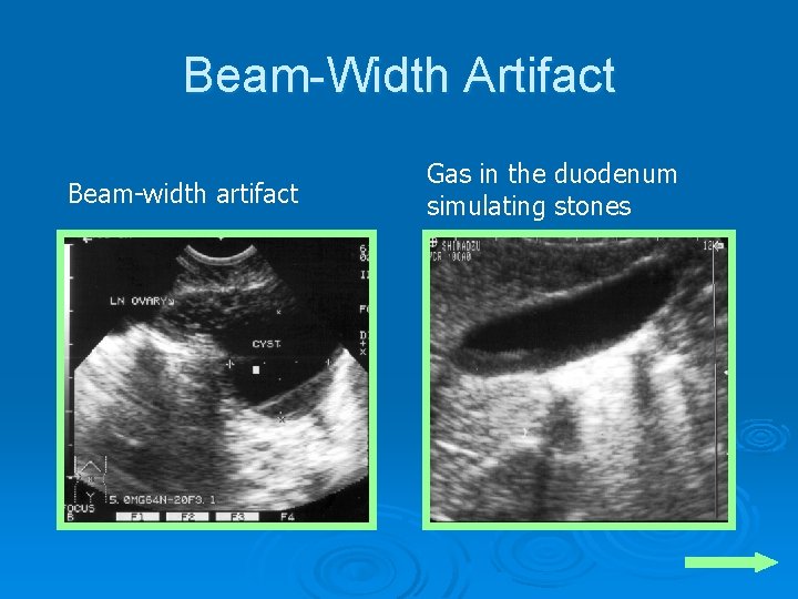 Beam-Width Artifact Beam-width artifact Gas in the duodenum simulating stones 