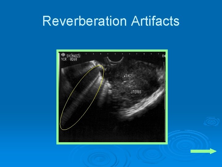 Reverberation Artifacts 