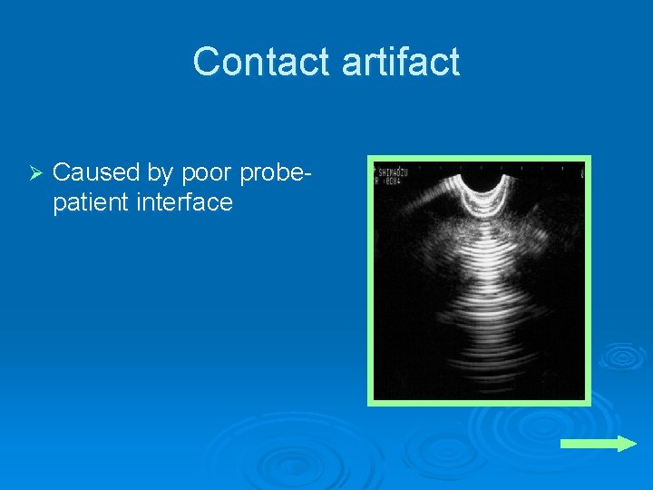 Contact artifact Ø Caused by poor probepatient interface 