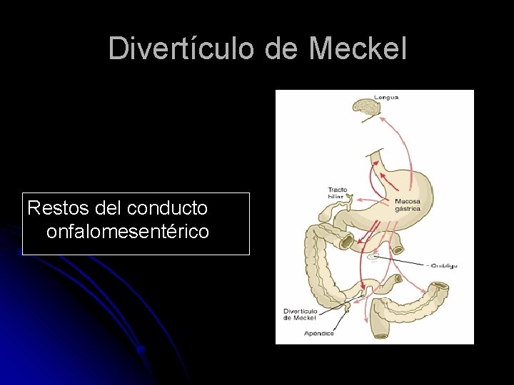 Divertículo de Meckel Restos del conducto onfalomesentérico 