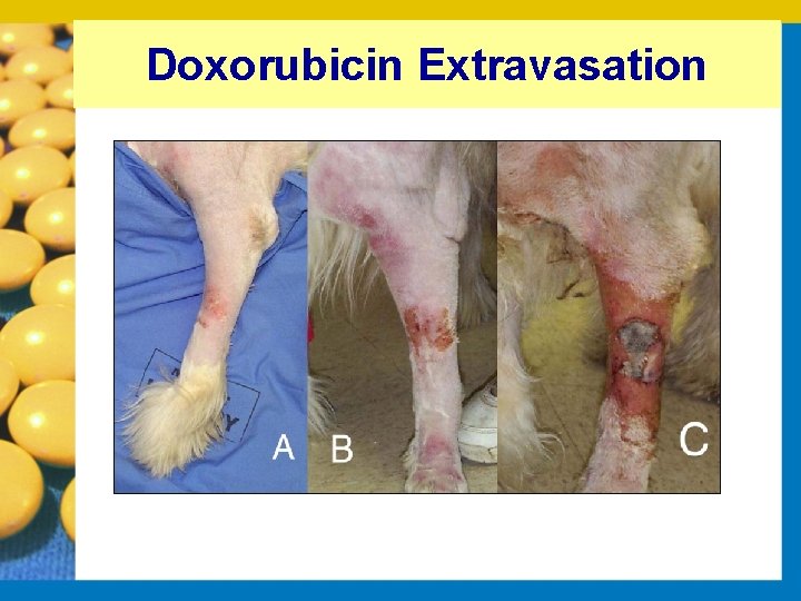 Doxorubicin Extravasation 