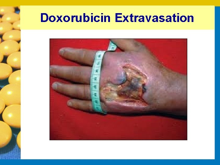 Doxorubicin Extravasation 