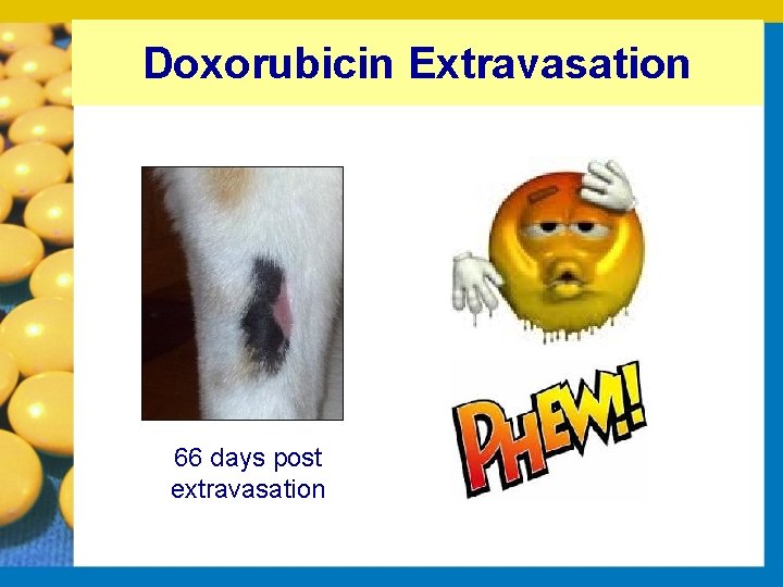 Doxorubicin Extravasation 66 days post extravasation 