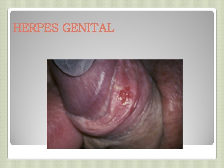 HERPES GENITAL 