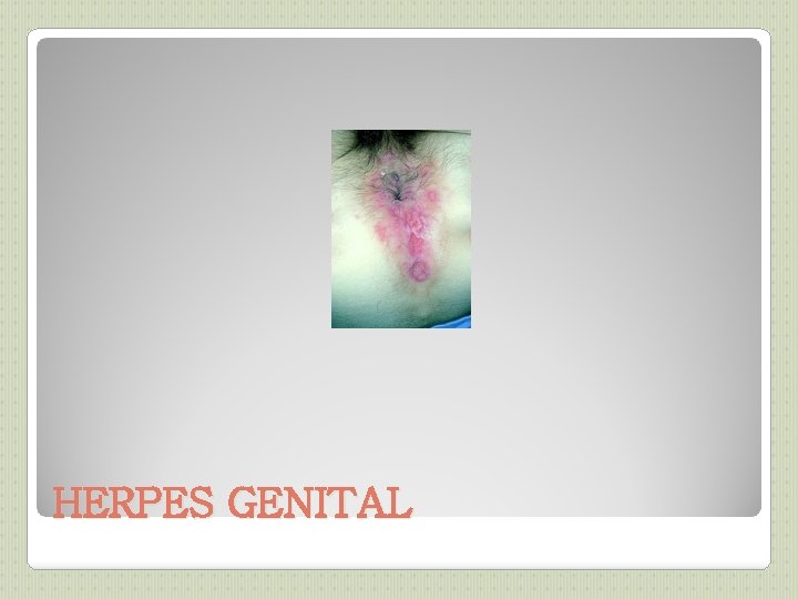 HERPES GENITAL 