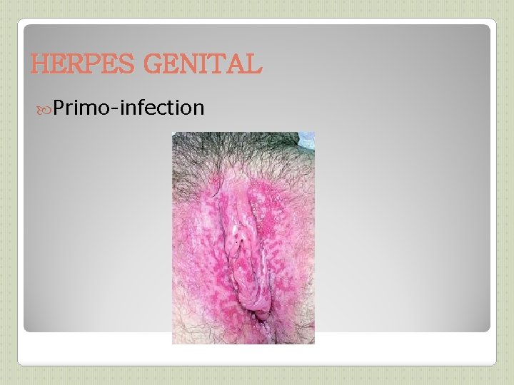 HERPES GENITAL Primo-infection 