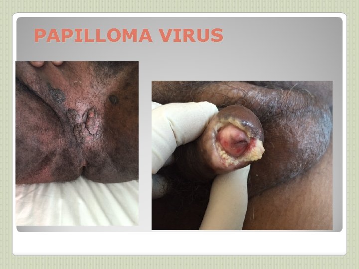 PAPILLOMA VIRUS 