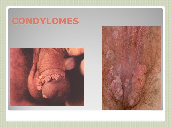 CONDYLOMES 