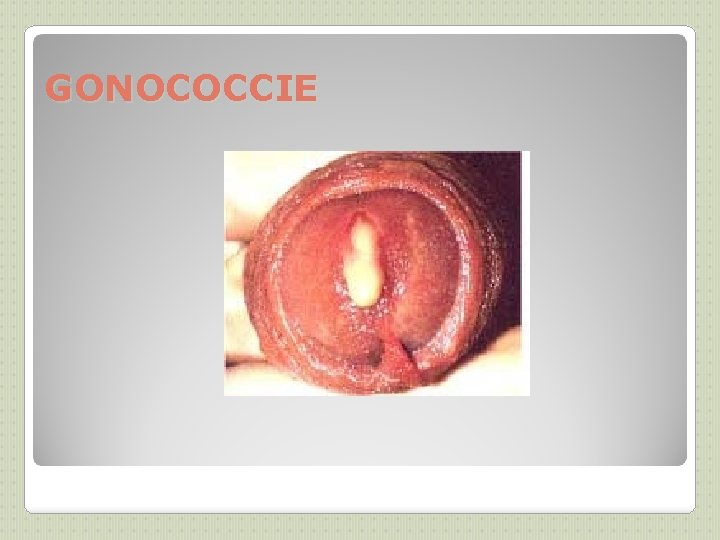 GONOCOCCIE 