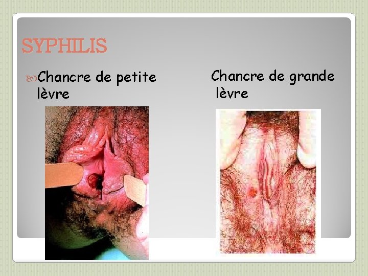 SYPHILIS Chancre lèvre de petite Chancre de grande lèvre 