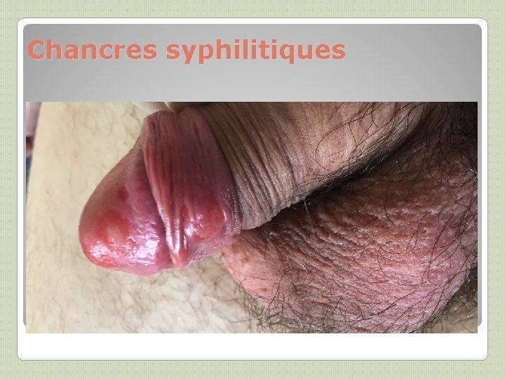 Chancres syphilitiques 