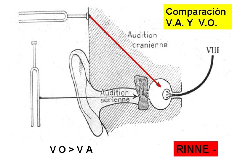 Comparación V. A. Y V. O. VO>VA RINNE - 