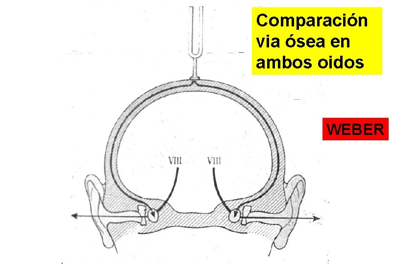 Comparación via ósea en ambos oidos WEBER 