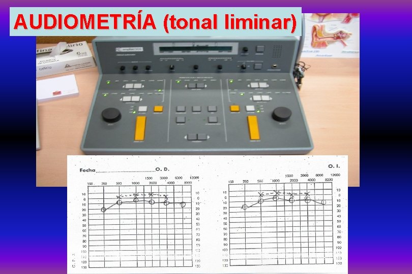 AUDIOMETRÍA (tonal liminar) 