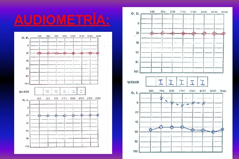 AUDIOMETRÍA: 