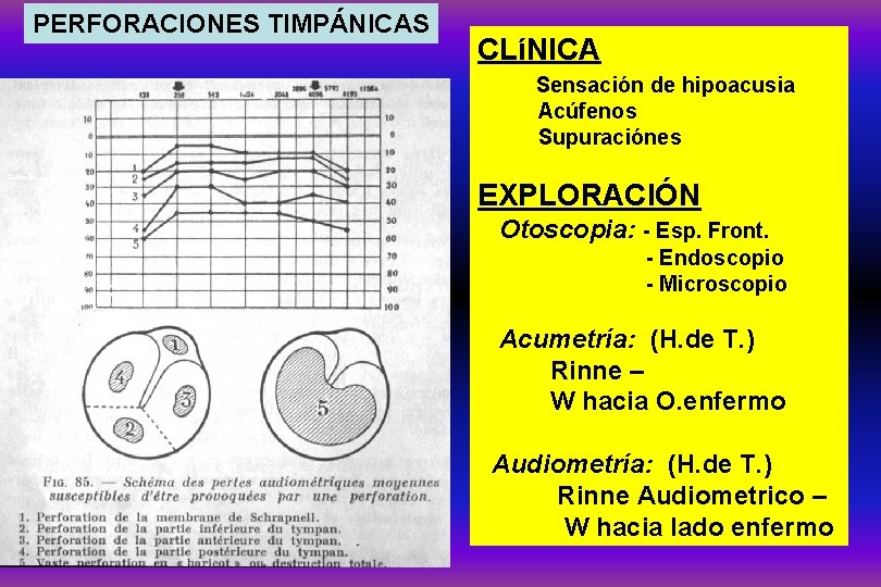 PERFORACIONES TIMPÁNICAS CLíNICA Sensación de hipoacusia Acúfenos Supuraciónes EXPLORACIÓN Otoscopia: - Esp. Front. -