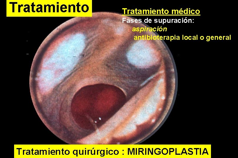 Tratamiento médico Fases de supuración: aspiración antibioterapia local o general Tratamiento quirúrgico : MIRINGOPLASTIA