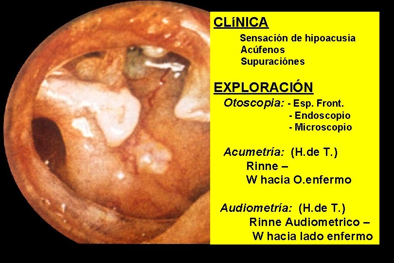 CLíNICA Sensación de hipoacusia Acúfenos Supuraciónes EXPLORACIÓN Otoscopia: - Esp. Front. - Endoscopio -