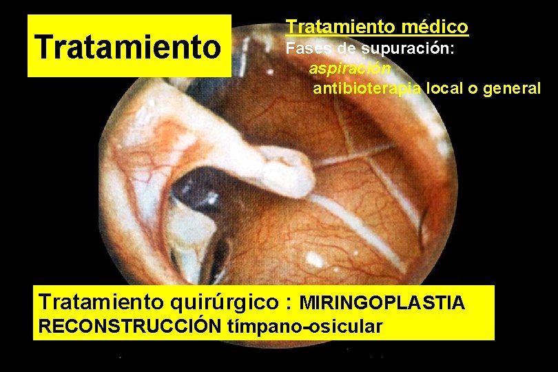 Tratamiento médico Fases de supuración: aspiración antibioterapia local o general Tratamiento quirúrgico : MIRINGOPLASTIA