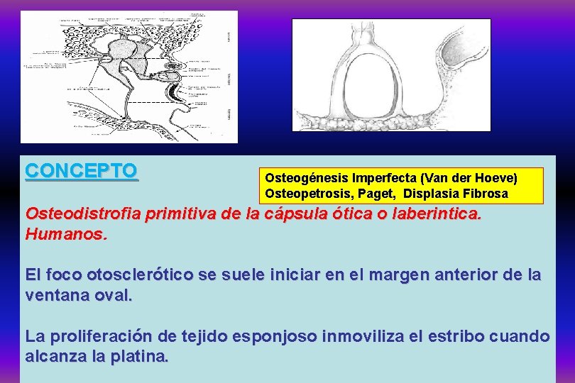 CONCEPTO Osteogénesis Imperfecta (Van der Hoeve) Osteopetrosis, Paget, Displasia Fibrosa Osteodistrofia primitiva de la