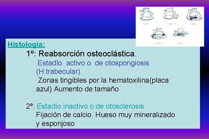 Histología: 1º: Reabsorción osteoclástica. Estadío activo o de otospongiosis (H. trabecular). Zonas tingibles por