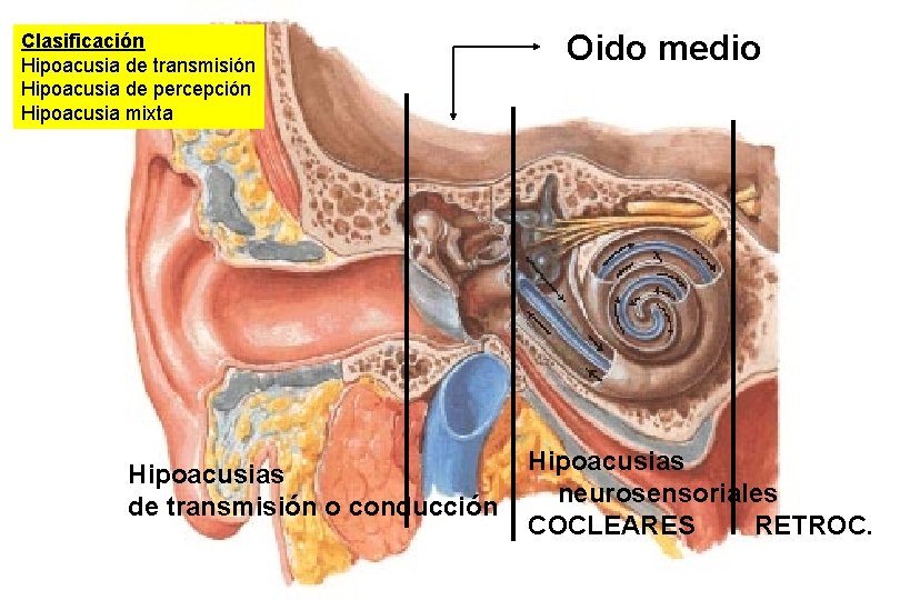 Clasificación Hipoacusia de transmisión Hipoacusia de percepción Hipoacusia mixta Hipoacusias de transmisión o conducción