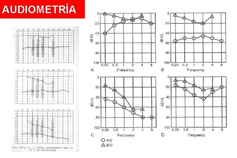 AUDIOMETRÍA 